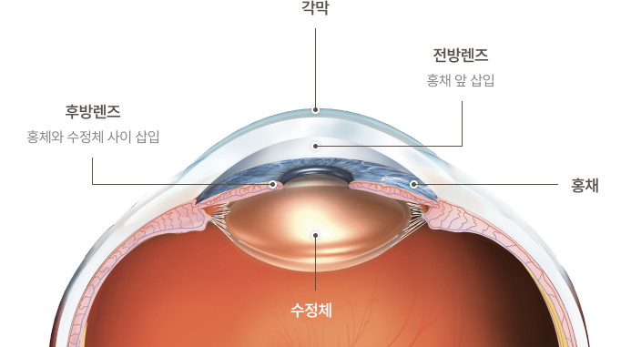 렌즈삽입술의 종류